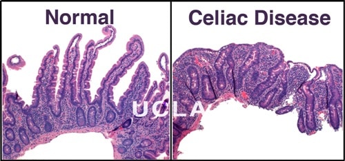 If you have Celiac Disease, gluten damages your intestines. Celiac disease UCLA Division of Digestive Diseases, Celiac Disease Division  http://gastro.ucla.edu/body.cfm?id=20